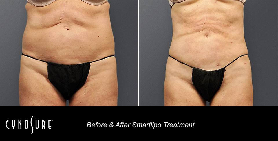 smartlipo_ba_slide3_.jpg