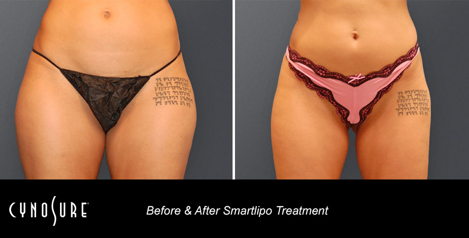 smartlipo_ba_slide4_.jpg